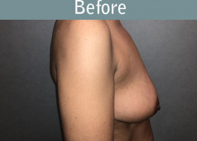 Milwaukee Plastic Surgery - Augmentation With Breast Lift - 3-5