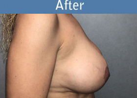 Milwaukee Plastic Surgery - Augmentation With Breast Lift - 3-6