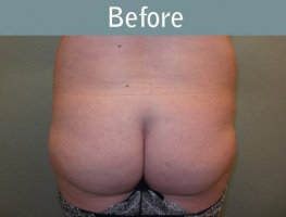 Milwaukee Plastic Surgery - Brazilian Butt Lift 1-1