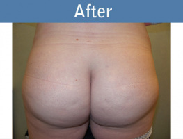 Milwaukee Plastic Surgery - Brazilian Butt Lift 1-2