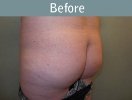 Milwaukee Plastic Surgery - Brazilian Butt Lift 1-3