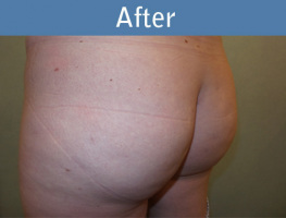 Milwaukee Plastic Surgery - Brazilian Butt Lift 1-4