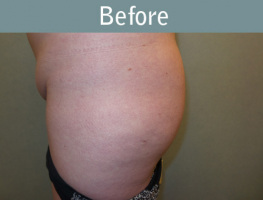 Milwaukee Plastic Surgery - Brazilian Butt Lift 1-5