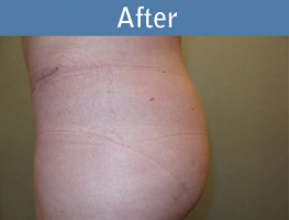 Milwaukee Plastic Surgery - Brazilian Butt Lift 1-6