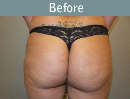 Milwaukee Plastic Surgery - Brazilian Butt Lift 2-1