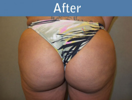 Milwaukee Plastic Surgery - Brazilian Butt Lift 2-2