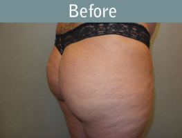 Milwaukee Plastic Surgery - Brazilian Butt Lift 2-3