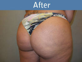 Milwaukee Plastic Surgery - Brazilian Butt Lift 2-4