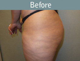 Milwaukee Plastic Surgery - Brazilian Butt Lift 2-5