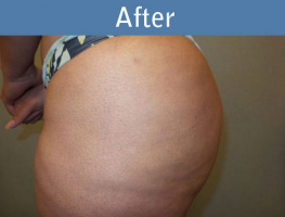 Milwaukee Plastic Surgery - Brazilian Butt Lift 2-6