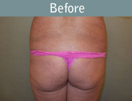 Milwaukee Plastic Surgery - Brazilian Butt Lift 3-1