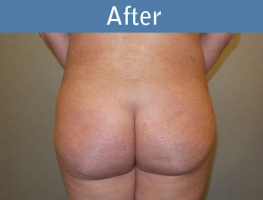 Milwaukee Plastic Surgery - Brazilian Butt Lift 3-2