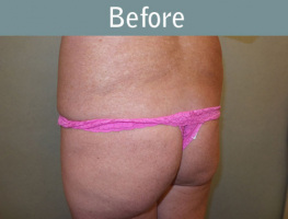 Milwaukee Plastic Surgery - Brazilian Butt Lift 3-3