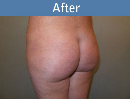 Milwaukee Plastic Surgery - Brazilian Butt Lift 3-4