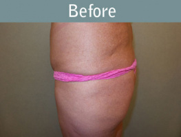 Milwaukee Plastic Surgery - Brazilian Butt Lift 3-5