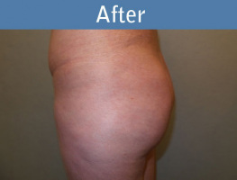 Milwaukee Plastic Surgery - Brazilian Butt Lift 3-6