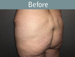 Milwaukee Plastic Surgery - Brazilian Butt Lift 4-1