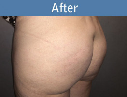 Milwaukee Plastic Surgery - Brazilian Butt Lift 4-2