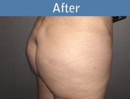 Milwaukee Plastic Surgery - Brazilian Butt Lift 4-4
