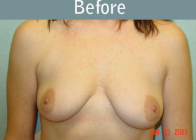 Milwaukee Plastic Surgery - Breast Augmentation - 1-1