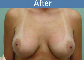 Milwaukee Plastic Surgery - Breast Augmentation - 1-2