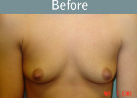 Milwaukee Plastic Surgery - Breast Augmentation - 10-1