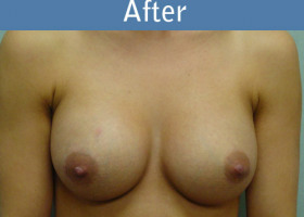 Milwaukee Plastic Surgery - Breast Augmentation - 10-2