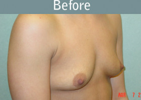 Milwaukee Plastic Surgery - Breast Augmentation - 11-1