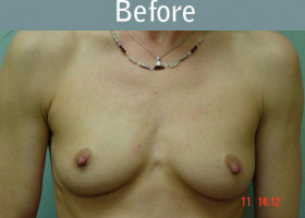 Milwaukee Plastic Surgery - Breast Augmentation - 13-1