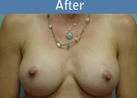 Milwaukee Plastic Surgery - Breast Augmentation - 13-2