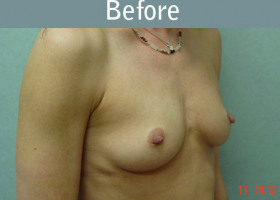 Milwaukee Plastic Surgery - Breast Augmentation - 14-1