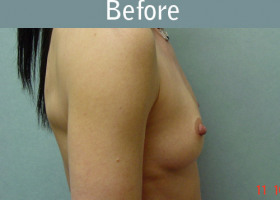 Milwaukee Plastic Surgery - Breast Augmentation - 15-1