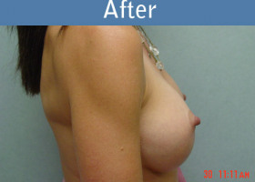 Milwaukee Plastic Surgery - Breast Augmentation - 15-2