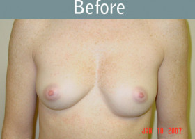 Milwaukee Plastic Surgery - Breast Augmentation - 16-1