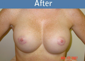 Milwaukee Plastic Surgery - Breast Augmentation - 16-2