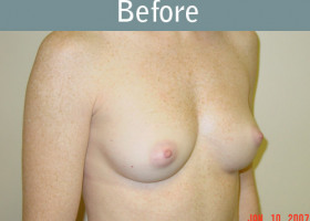 Milwaukee Plastic Surgery - Breast Augmentation - 17-1