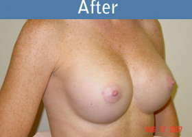 Milwaukee Plastic Surgery - Breast Augmentation - 17-2