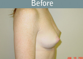 Milwaukee Plastic Surgery - Breast Augmentation - 18-1