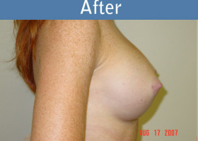 Milwaukee Plastic Surgery - Breast Augmentation - 18-2
