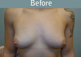 Milwaukee Plastic Surgery - Breast Augmentation - 19-1