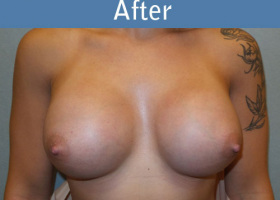 Milwaukee Plastic Surgery - Breast Augmentation - 19-2