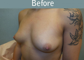 Milwaukee Plastic Surgery - Breast Augmentation - 19-3