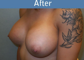 Milwaukee Plastic Surgery - Breast Augmentation - 19-4