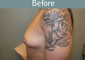 Milwaukee Plastic Surgery - Breast Augmentation - 19-5