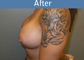 Milwaukee Plastic Surgery - Breast Augmentation - 19-6