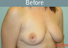 Milwaukee Plastic Surgery - Breast Augmentation - 2-1