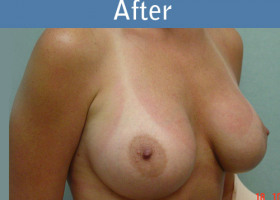 Milwaukee Plastic Surgery - Breast Augmentation - 2-2