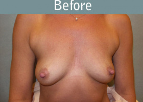 Milwaukee Plastic Surgery - Breast Augmentation - 20-1