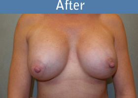 Milwaukee Plastic Surgery - Breast Augmentation - 20-2