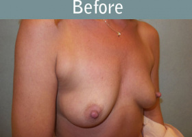 Milwaukee Plastic Surgery - Breast Augmentation - 20-3